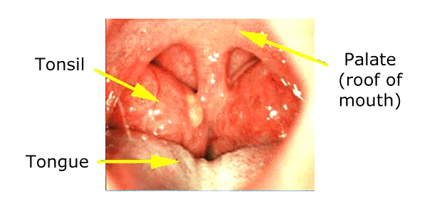 normal tonsils vs infected tonsils