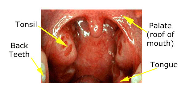 normal tonsils vs infected tonsils