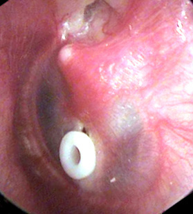 PE Tube in place in the eardrum 